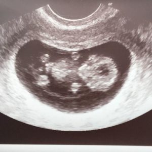 10 ssw ultraschallbild 2 - 10. SSW (Schwangerschaftswoche): Alle Infos, Größe & Entwicklung