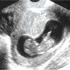 10 ssw ultraschallbild 3 - 10. SSW (Schwangerschaftswoche): Alle Infos, Größe & Entwicklung