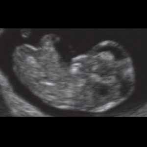 10 ssw ultraschallbild - 10. SSW (Schwangerschaftswoche): Alle Infos, Größe & Entwicklung