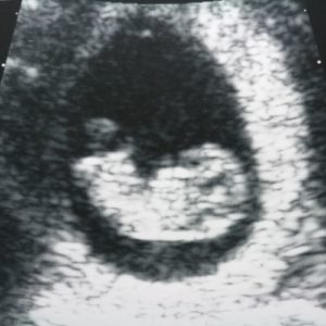 10 ssw ultraschallbild 4 - 10. SSW (Schwangerschaftswoche): Alle Infos, Größe & Entwicklung