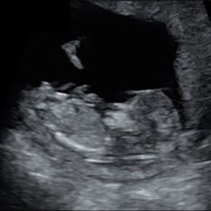 11 ssw ultraschall - 11. SSW (Schwangerschaftswoche): Alle Infos, Größe & Entwicklung