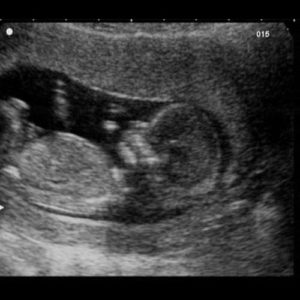 12 ssw ultraschall 1 - 12. SSW (Schwangerschaftswoche): Alle Infos, Größe & Entwicklung