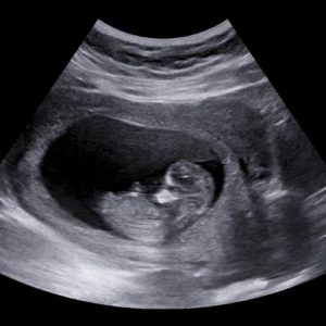 12 ssw ultraschall 2 - 12. SSW (Schwangerschaftswoche): Alle Infos, Größe & Entwicklung