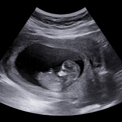 Junge ssw ultraschall 12 Ultraschallbild junge