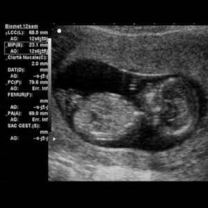 12 ssw ultraschall 3 - 12. SSW (Schwangerschaftswoche): Alle Infos, Größe & Entwicklung