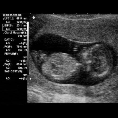 ᐅ 12 Ssw Schwangerschaftswoche Alle Infos Grosse Entwicklung
