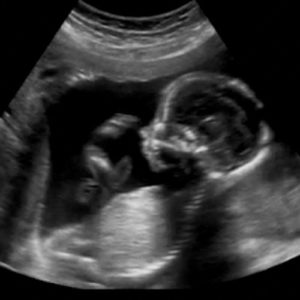 13 ssw ultraschallbild 2 - 13. SSW (Schwangerschaftswoche): Alle Infos, Größe & Entwicklung