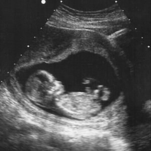 13 ssw ultraschallbild 3 - 13. SSW (Schwangerschaftswoche): Alle Infos, Größe & Entwicklung