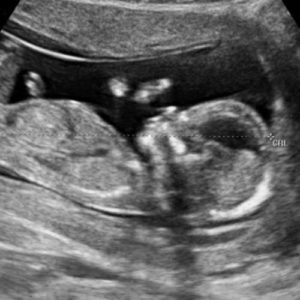 13 ssw ultraschallbild - 13. SSW (Schwangerschaftswoche): Alle Infos, Größe & Entwicklung