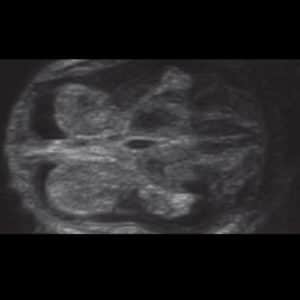 13 ssw ultraschallbild 4 - 13. SSW (Schwangerschaftswoche): Alle Infos, Größe & Entwicklung