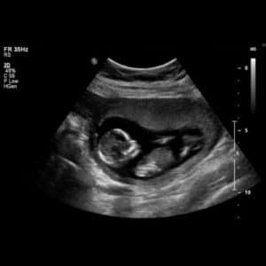 14 ssw ultraschallbild 2 - 14. SSW (Schwangerschaftswoche): Alle Infos, Größe & Entwicklung