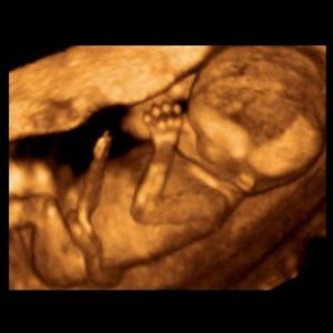14 ssw ultraschallbild 3 - 14. SSW (Schwangerschaftswoche): Alle Infos, Größe & Entwicklung