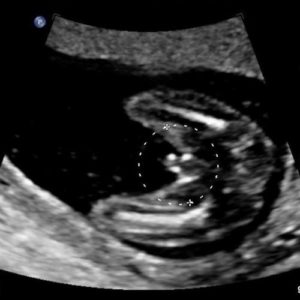 14 ssw ultraschallbild - 14. SSW (Schwangerschaftswoche): Alle Infos, Größe & Entwicklung