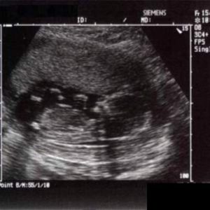 14 ssw ultraschallbild 4 - 14. SSW (Schwangerschaftswoche): Alle Infos, Größe & Entwicklung