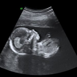 Ultraschallbild aus der 16. Woche