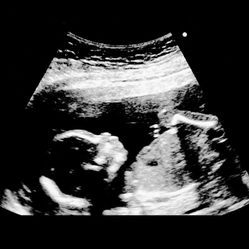 Ssw erkennen 18 Frühe Schwangerschaftsanzeichen: