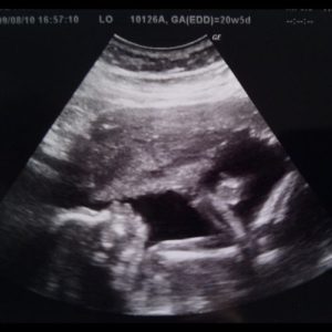 Ultraschallbild aus der 21. SSW