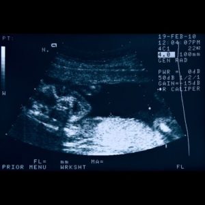 Ultraschallbild aus der 22. SSW
