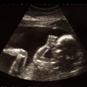 Ultraschallbild aus der 23. SSW