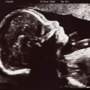 Ultraschallbild aus der 23. SSW