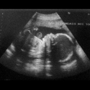 25 ssw ultraschallbild 2 - 25. SSW (Schwangerschaftswoche): Alle Infos, Größe & Entwicklung