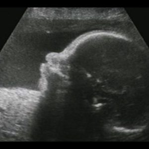 Ultraschallbild aus der 27. SSW