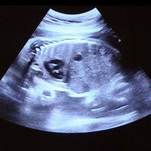 Ultraschallbild aus der 28. Woche