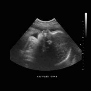 Ultraschallbild aus der 29. SSW