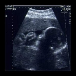 Ultraschallbild aus der 30. Woche