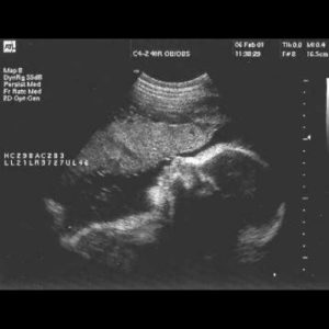 Ultraschallbild aus der 31. SSW