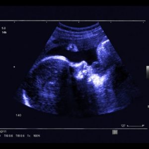Ultraschallbild aus der 32. SSW