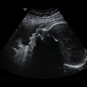 Ultraschallbild aus der 35. SSW