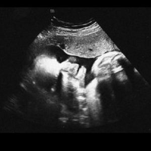 Ultraschallbild aus der 35. Woche