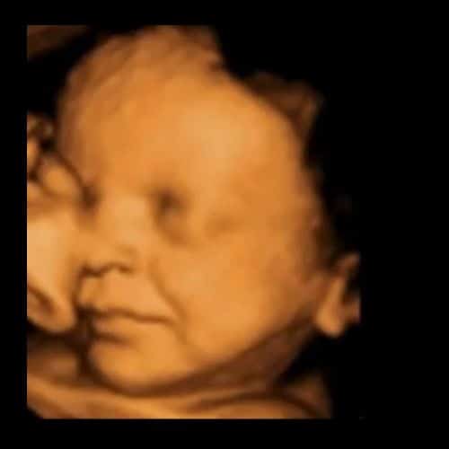 3D-Ultraschallbild aus der 36. Woche
