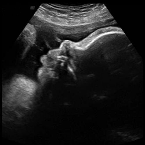 Ultraschallbild aus der 36. SSW
