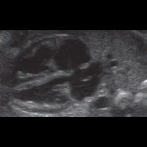 Die 4 Herzkammern und Herzklappen des Babys