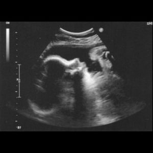 Ultraschallbild aus der 41. SSW