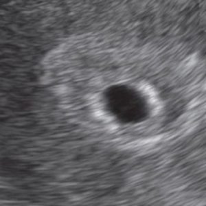 5 ssw ultraschallbild 1 - 5. SSW (Schwangerschaftswoche): Alle Infos, Größe & Entwicklung