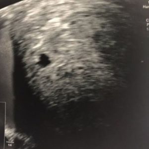 5 ssw ultraschallbild 2 - 5. SSW (Schwangerschaftswoche): Alle Infos, Größe & Entwicklung