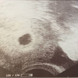 5 ssw ultraschallbild 3 - 5. SSW (Schwangerschaftswoche): Alle Infos, Größe & Entwicklung