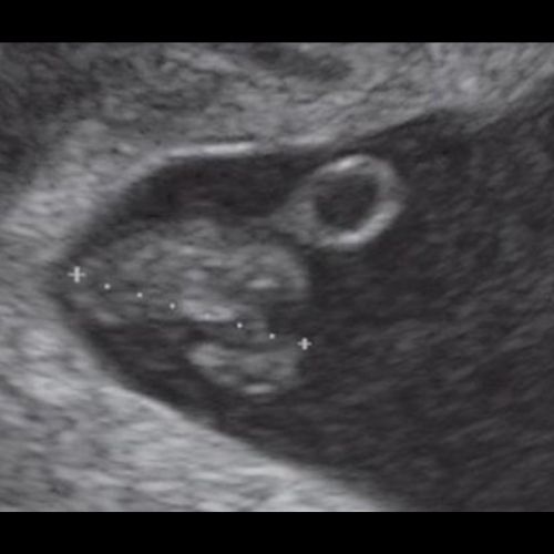 7 ssw ultraschallbild 2 - 7. SSW (Schwangerschaftswoche): Alle Infos, Größe & Entwicklung