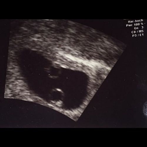 7 ssw ultraschallbild 3 - 7. SSW (Schwangerschaftswoche): Alle Infos, Größe & Entwicklung