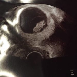 8 ssw ultraschallbild 2 - 8. SSW (Schwangerschaftswoche): Alle Infos, Größe & Entwicklung