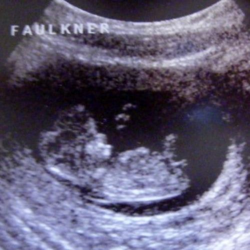 9 ssw ultraschall 3 - 9. SSW (Schwangerschaftswoche): Alle Infos, Größe & Entwicklung
