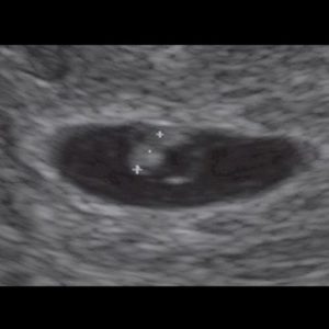 ultraschallbild 6 ssw 2 - 6. SSW (Schwangerschaftswoche): Alle Infos, Größe & Entwicklung