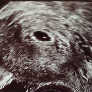 ultraschallbild 6 ssw - 6. SSW (Schwangerschaftswoche): Alle Infos, Größe & Entwicklung