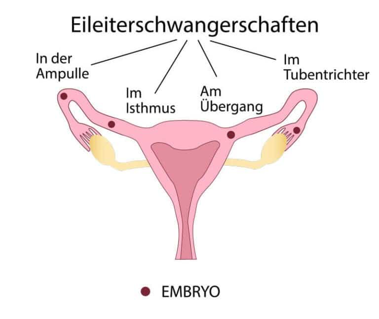 eileiterschwangerschaft arten - Eileiterschwangerschaft: Ursachen, Symptome, Verlauf & Behandlung