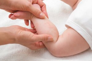 nesselsucht 3 - Nesselsucht bei Baby, Kleinkind oder Kind erkennen und behandeln