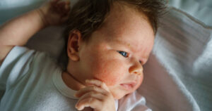 Neurodermitis 1 1 - Neurodermitis beim Baby: Das ist jetzt wichtig