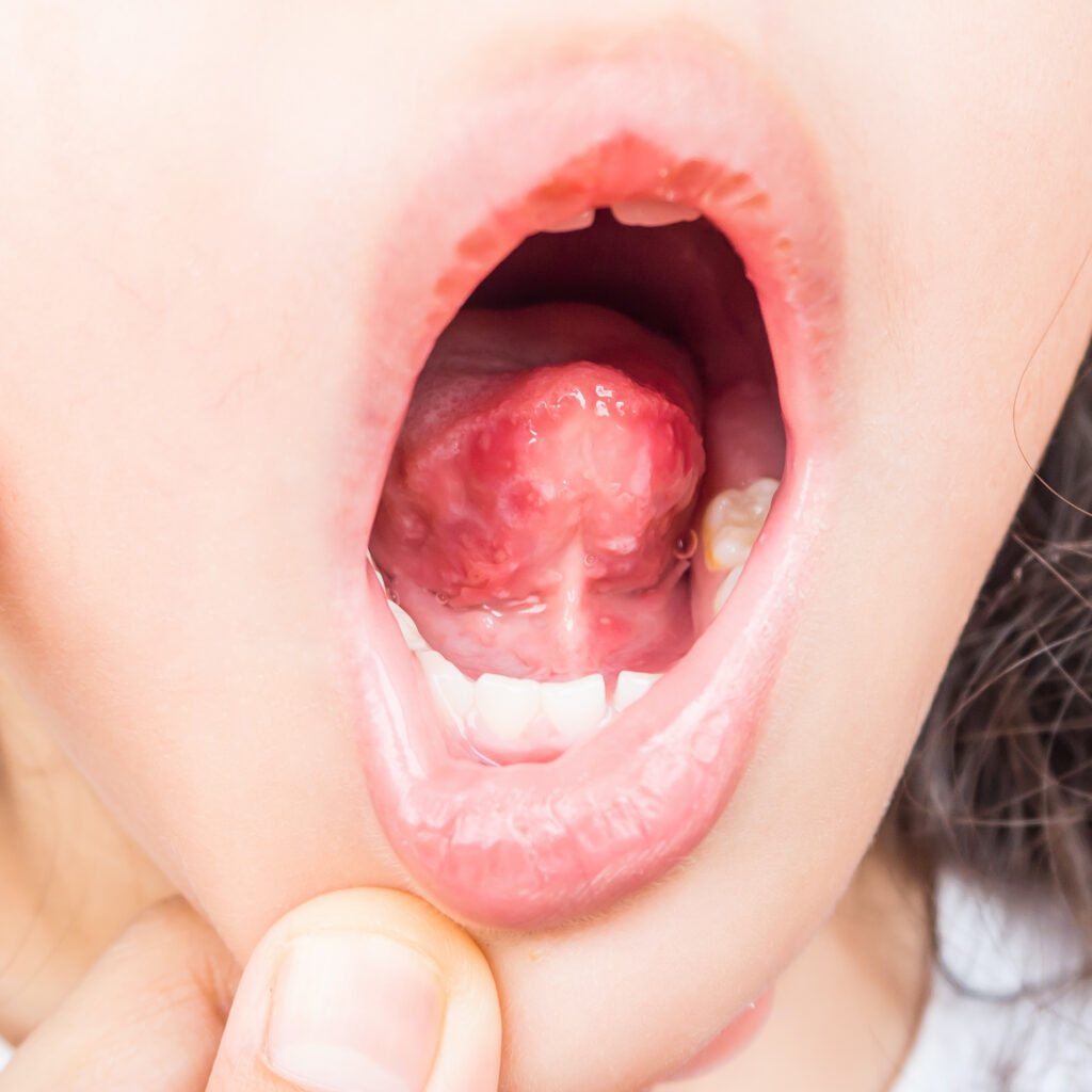 hand mund fuss krankheit apthen 600x600 2 - Hand-Fuß-Mund-Krankheit: Symptome, Ansteckung und Tipps